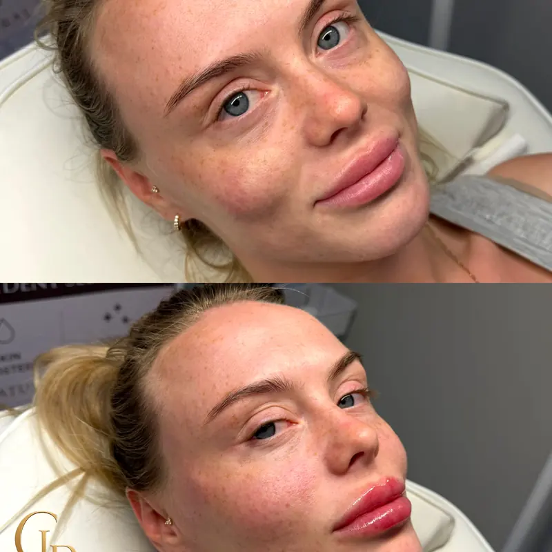 Before and after lip filler at Haus of CLB
